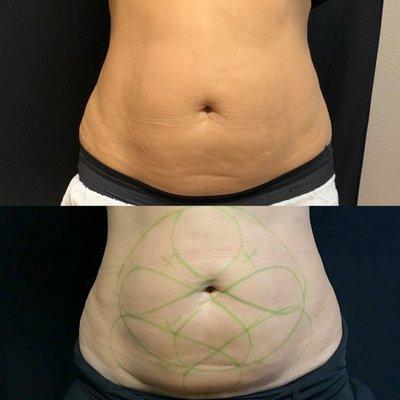 Freeze M.D. Coolsculpting Center