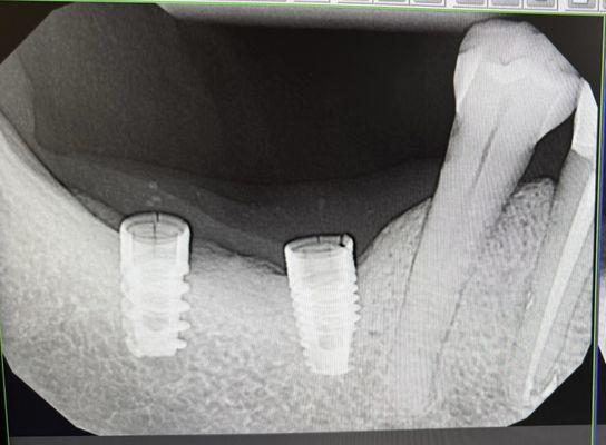 Cheap parts from a different country were used and both implants broke in less than 5 years