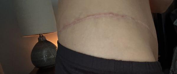 Scars are super high can't wear anything short! Shows in all bathing suits shorts etc!
