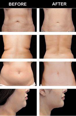 Before and After Body Sculpting Services