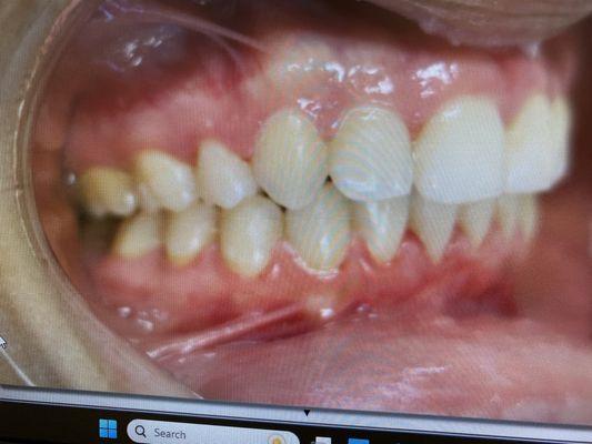 After treatment