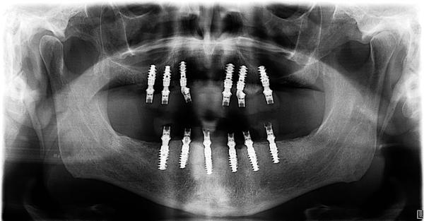 Dental Implants. 3D CT Scan.
