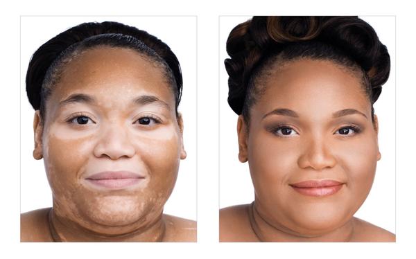 Vitiligo, Jane Iredale the Skin Care Makeup. Will cover.Products used: Amazing Base , and D2o hydration spray...