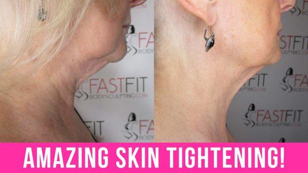 Fast Fit Body Sculpting Fat Weight Loss Review Before and After Skin Tightening