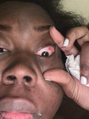 A bloodshot in my eye is ridiculous!