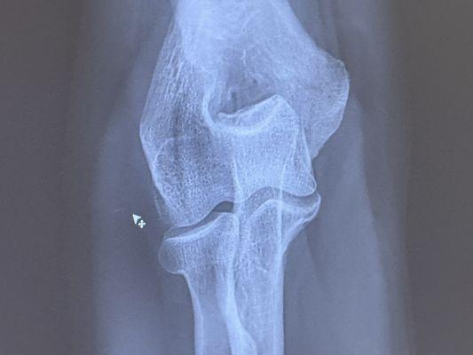 Personalized Orthopedics of the Palm Beaches