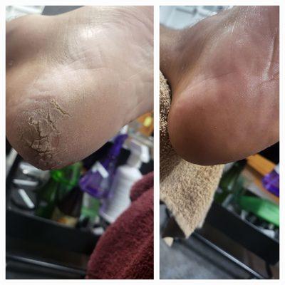 Callus reduction