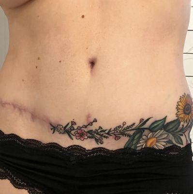 I am very pale and my scars are getting lighter. This was at 1 year after the surgery.