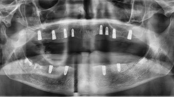 Full mouth reconstruction
