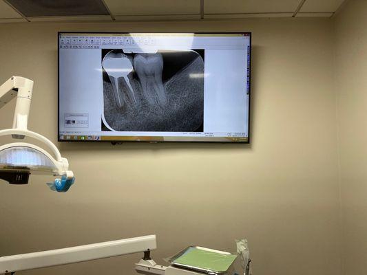 RootVision Endo