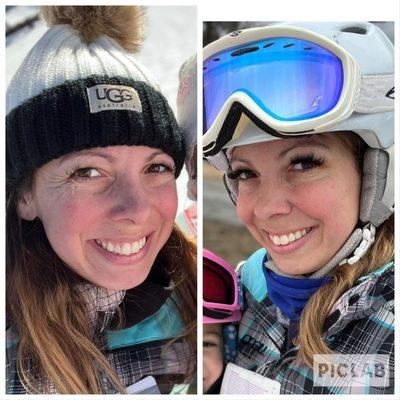 Patient treated for crows feet