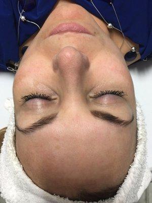 Hyper-pigmentation lightened with one microdermabrasion service.
