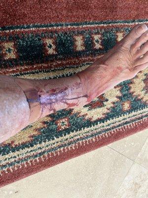 Photo of my leg upon arriving home shortly after my Biopsy appointment. I felt like a number and not person