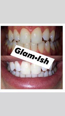 Teeth whitening, come let me brighten your teeth in as little as 1 hour. I can lift those coffee, tea stains that you have been dealing with