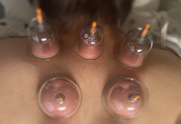 Cupping Therapy