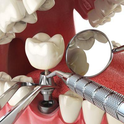 Affordable Dental Implants Phoenix