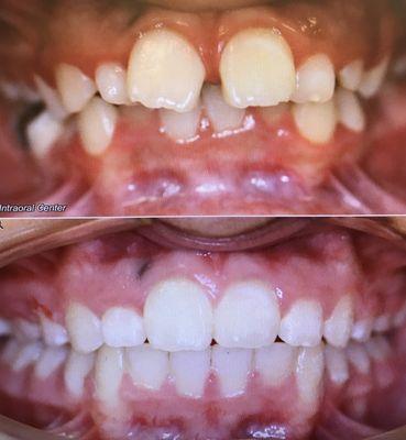 Before and after braces with Dr. B !
