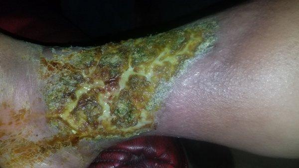 Inflected venous ulcer