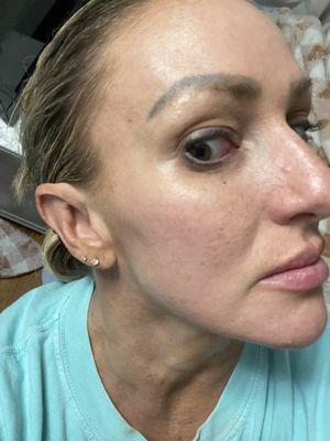 Jawline enhanced with filler and Botox. LOVE the outcome.
