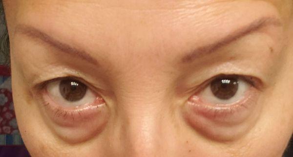 Pre-surgery. What I was hiding behind my glasses for years. Horrible.