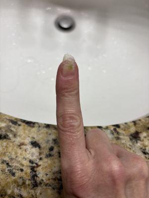 NAIL FUNGUS