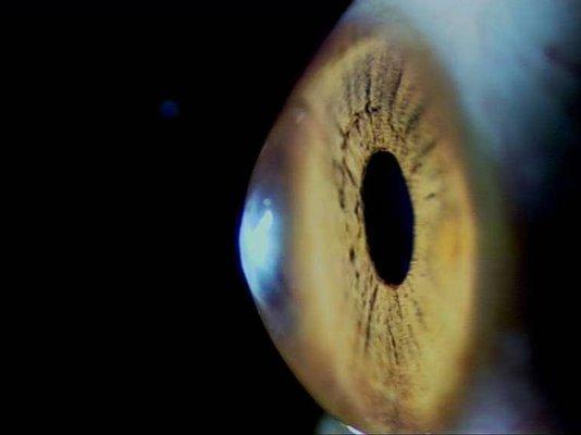 We provide Keratoconus Treatments.