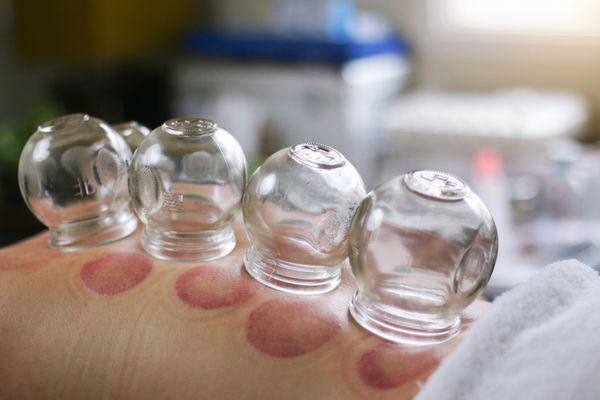 Cupping