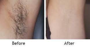 Unwanted Armpit Hair