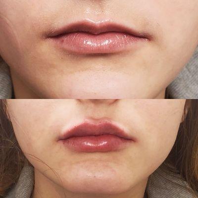 Natural Injections by Laura