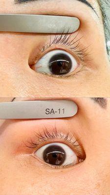 Unhygienic practices leading to sty on left upper eyelid
