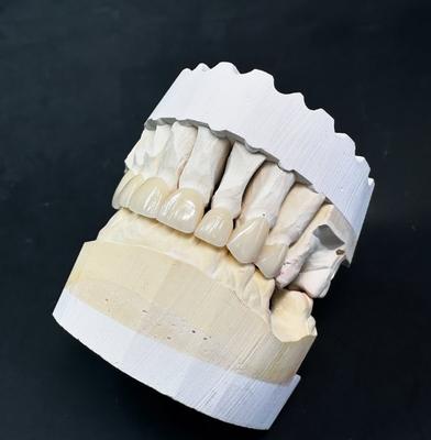 8-unit anterior crowns in layered zirconia
