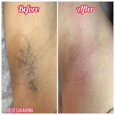 Armpit sugaring before and after