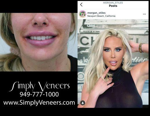 Simply Veneers specialized in complete smile makeover transformation with porcelain veneers