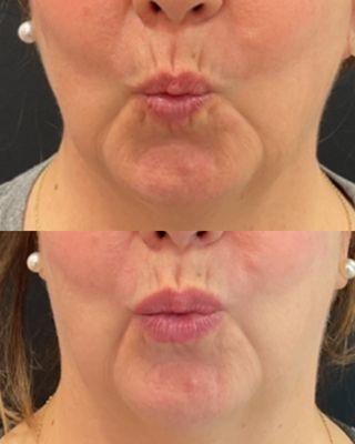 Filled lips look natural and not overdone at Pure Dermatology!