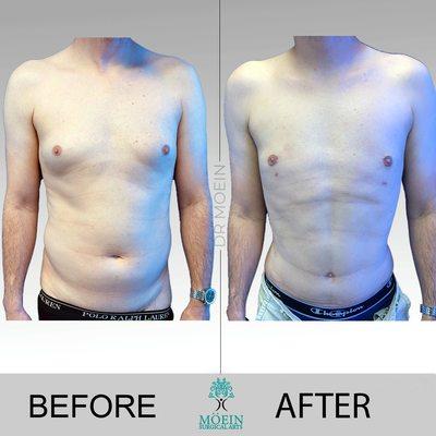 Liposuction Center Moein Surgical Arts