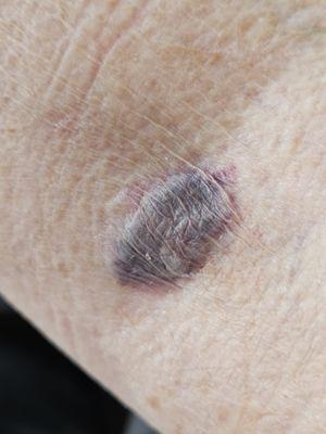 This is a bruise from having blood drawn 30 minutes ago at Labcorp on US Hwy 98 S.