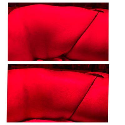 Red light therapy, hand manipulation and laser liposuction treatment.