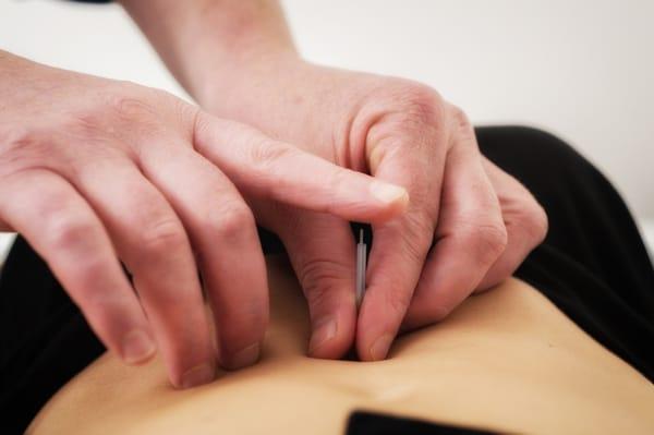 Oded Schneiderman Acupuncture