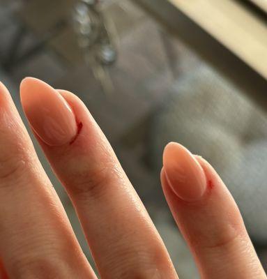 Cut and bleeding cuticles