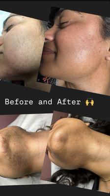 Flawlyss Electrolysis By Gina