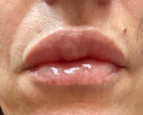 20 Days after bad filler technique