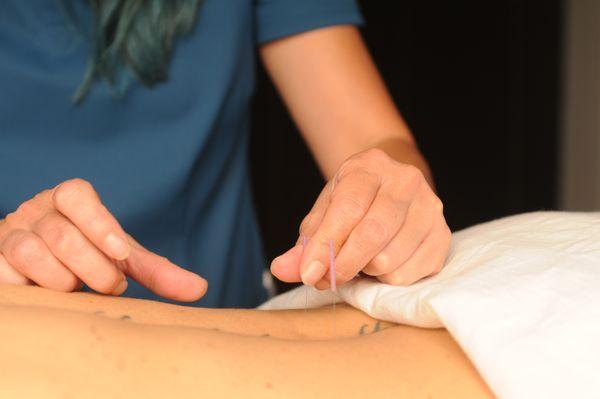 Acupuncture Denver