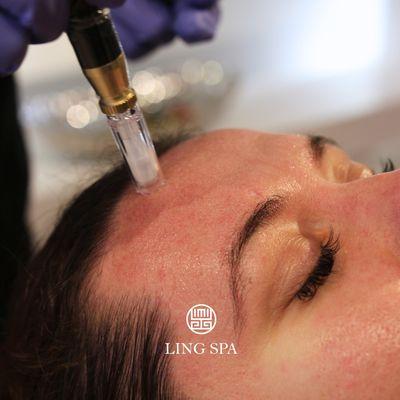 Microneedling w/ Rejuran