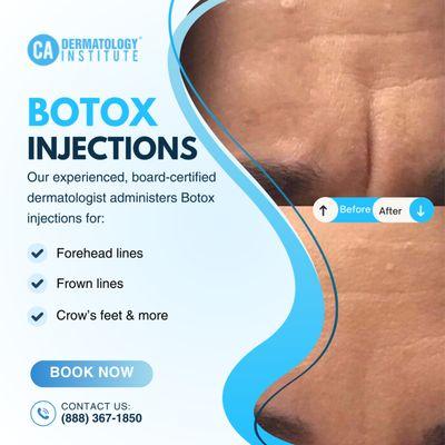 Contact us to learn more about our Botox injection services.