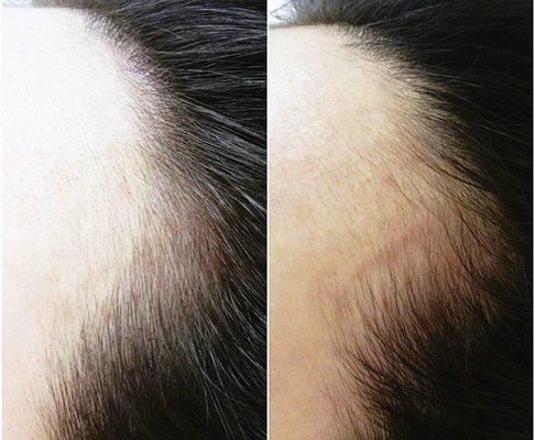 hairline microblading