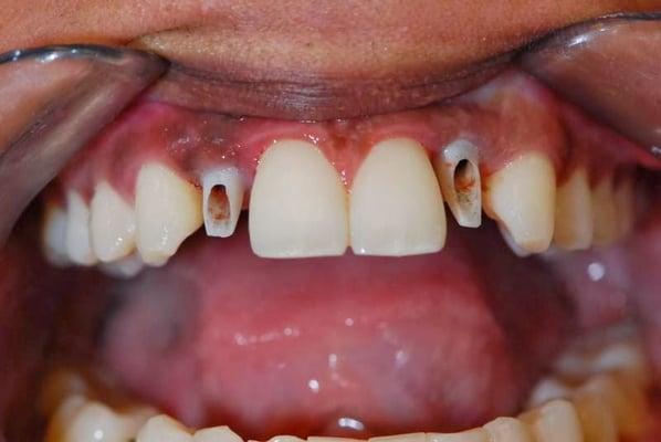 One happy patient with two new dental implants provided by Sentry!