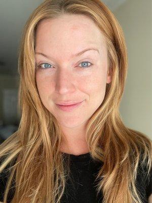 Microdermabrasion and Cooling Mask - Day After Treatment