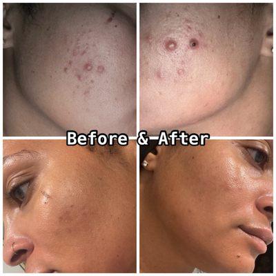 6months of consistent use of the products Ryane recommended from my skin analysis