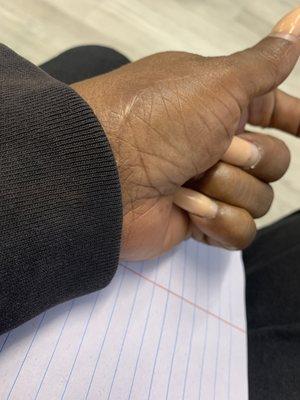 Thumb surgery last year