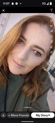 Missing teeth .some bone loss